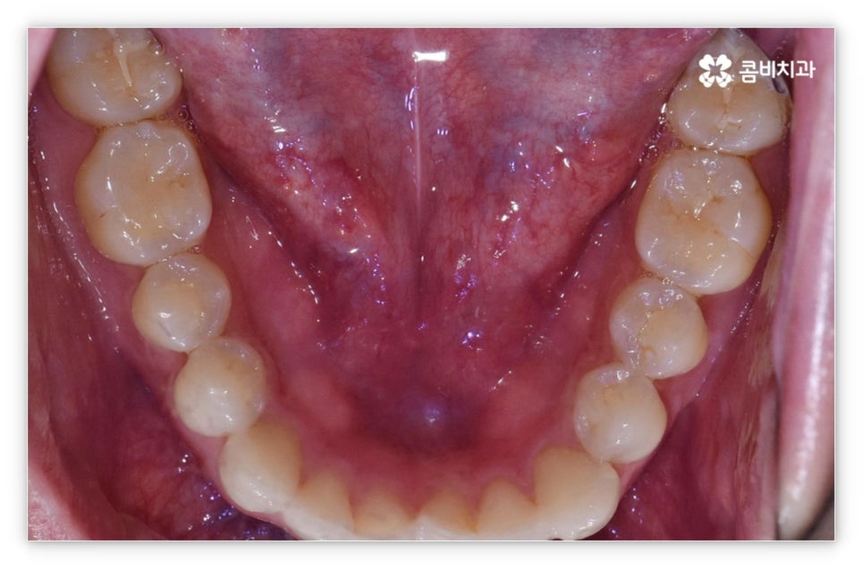 앞니설측교정 망설여질때는 관련 이미지 5