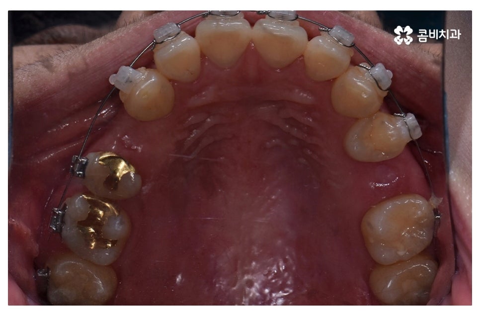 덧니교정 정확하게 알아보려면 관련 이미지 9