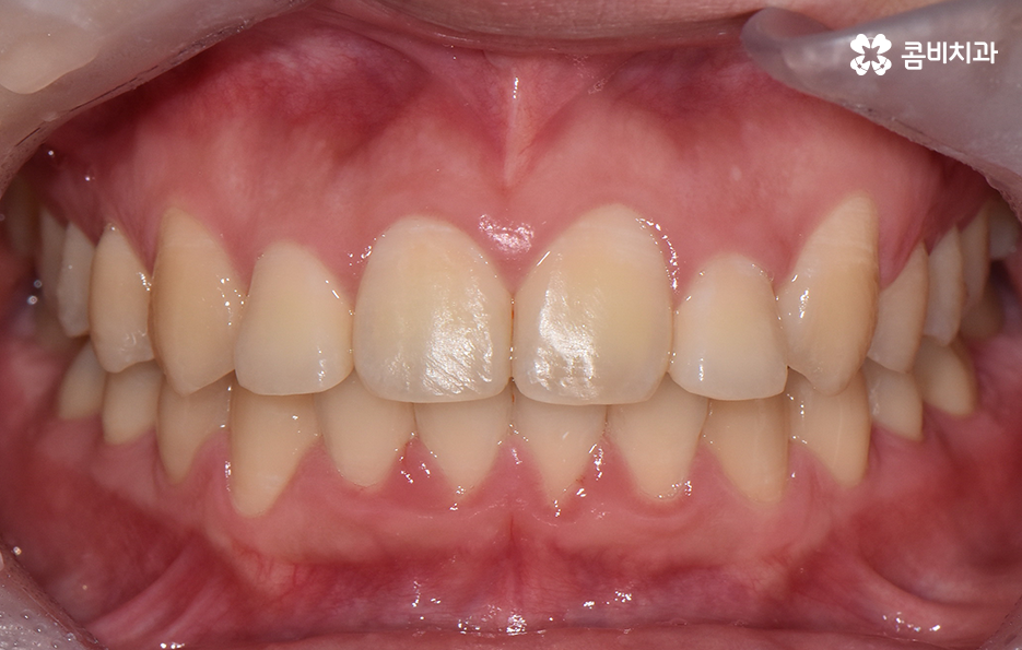 덧니 비발치 교정 자연스럽게 가능한 경우도 있어요 관련 이미지 7
