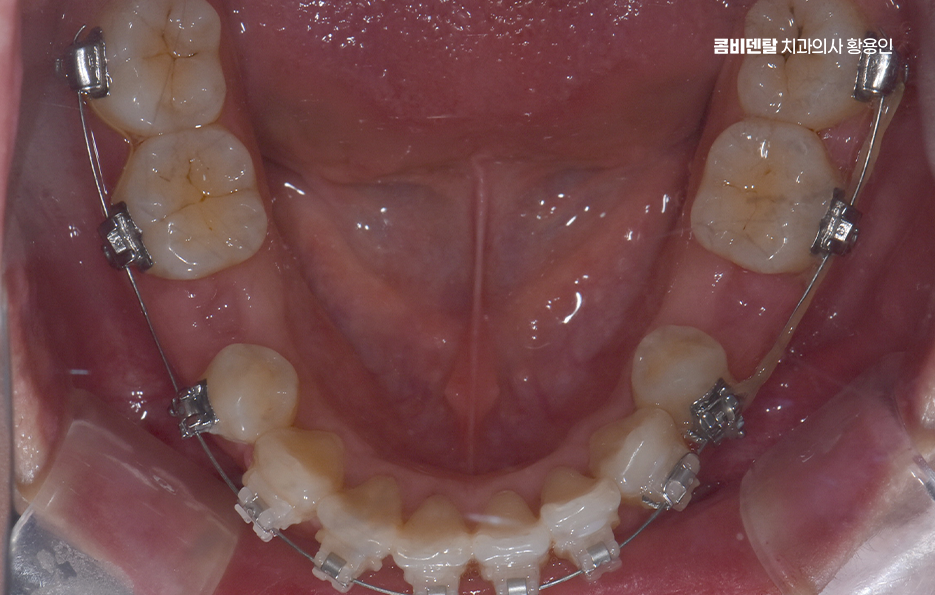 돌출입 팔자주름 교정 얼마나 바뀔까요 관련 이미지 9