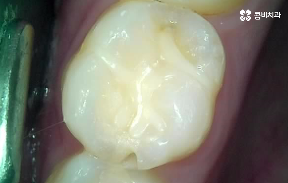 레진 인레이 치료 후 2차충치 왜 발생하고 어떻게 대처할까 관련 이미지 3