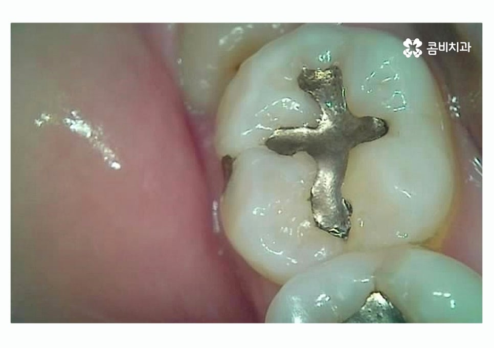 충치 떼우기 스무살이후에 조심해야 할 점은? 관련 이미지 3