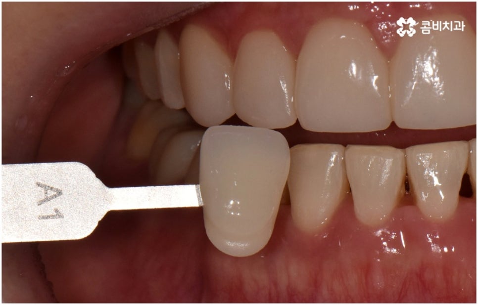 누런치아 하얗게 바꾸고 싶다면 관련 이미지 10