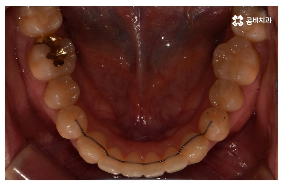덧니교정 정확하게 알아보려면 관련 이미지 16