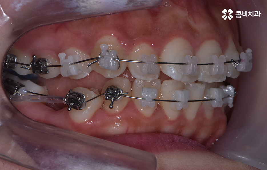 덧니 발치 교정 이런 경우에는 필요합니다 관련 이미지 8