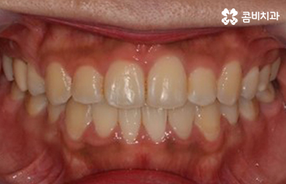 클리피씨교정 알아볼 때 꼭 신경 써야 하는 점은! 관련 이미지 11