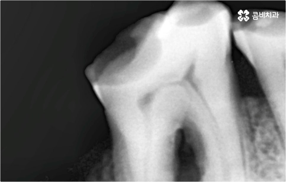 전악임플란트 고려할 사항들은 관련 이미지 3