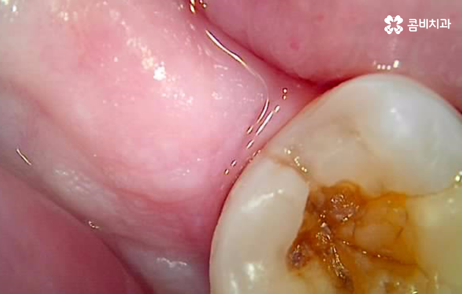 치아 사이 충치 까다로운 이유부터 알아보시죠 관련 이미지 5