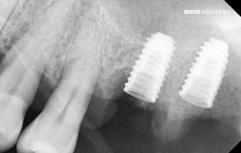 어르신 임플란트 지원 현명하게 활용하려면 관련 이미지 4