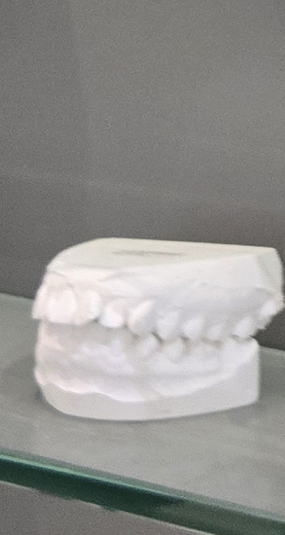 윗니 전체 임플란트 뭐부터 해야할까 관련 이미지 33