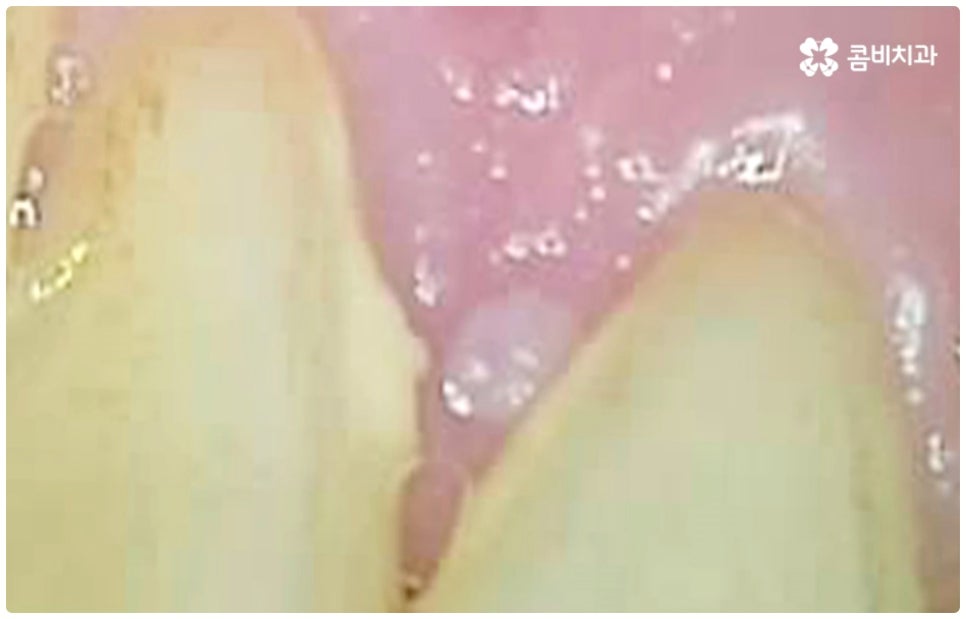 충치치료종류 알아볼까요? 관련 이미지 2