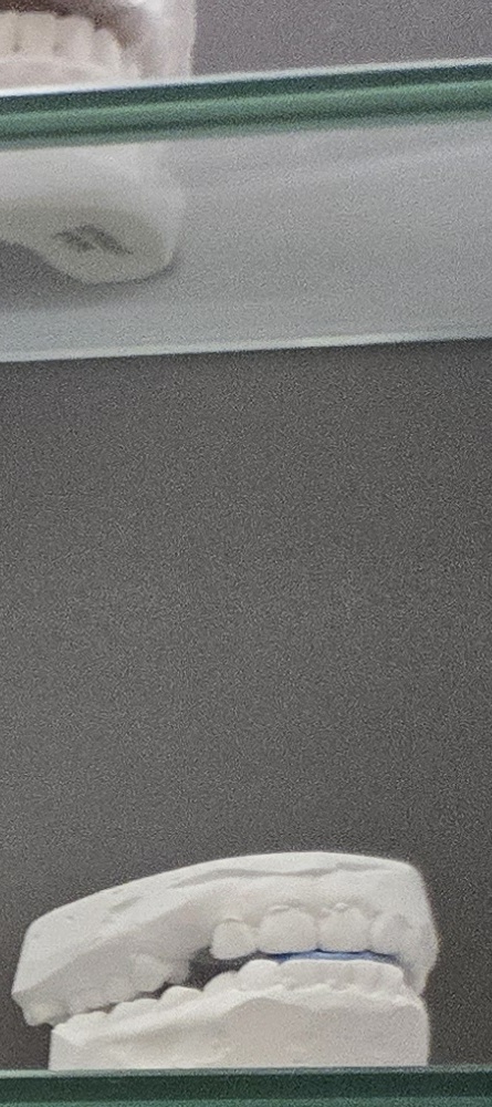 앞이빨 임플란트 과정 주의해야할 포인트는 관련 이미지 17