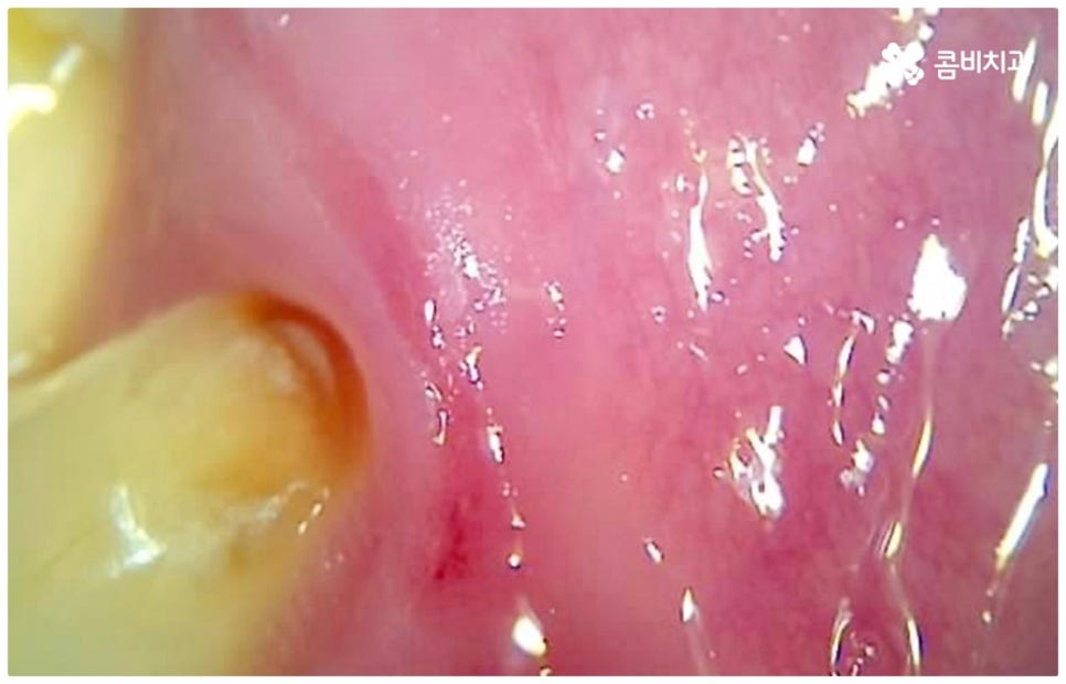 어금니충치치료 아프다면 빨리 관련 이미지 8