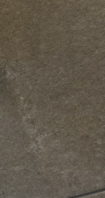 반대교합 치아교정 해결 가능할까 관련 이미지 26