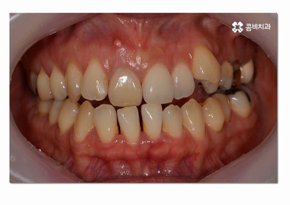 3급 부정교합 지금이라도 고치고 싶다면 관련 이미지 1