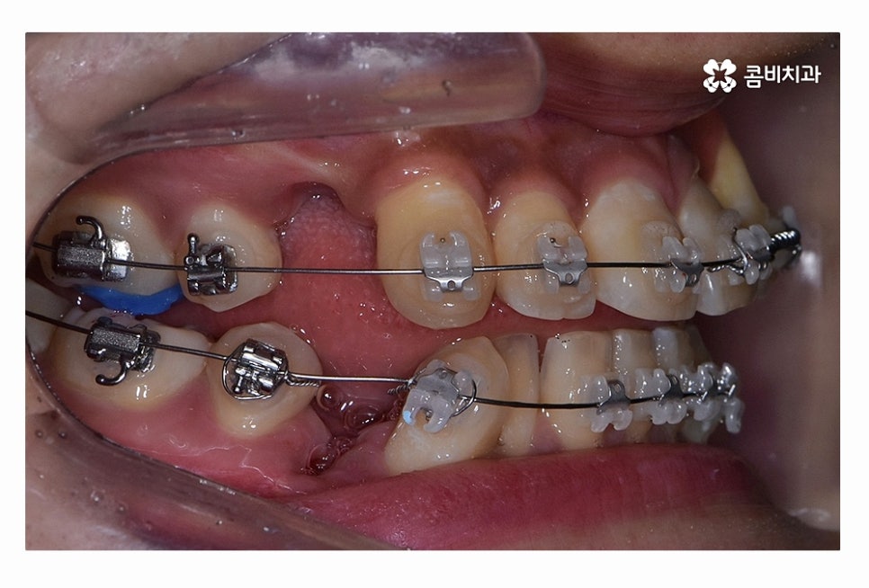 덧니 발치 필수적으로 하는건가요 관련 이미지 8
