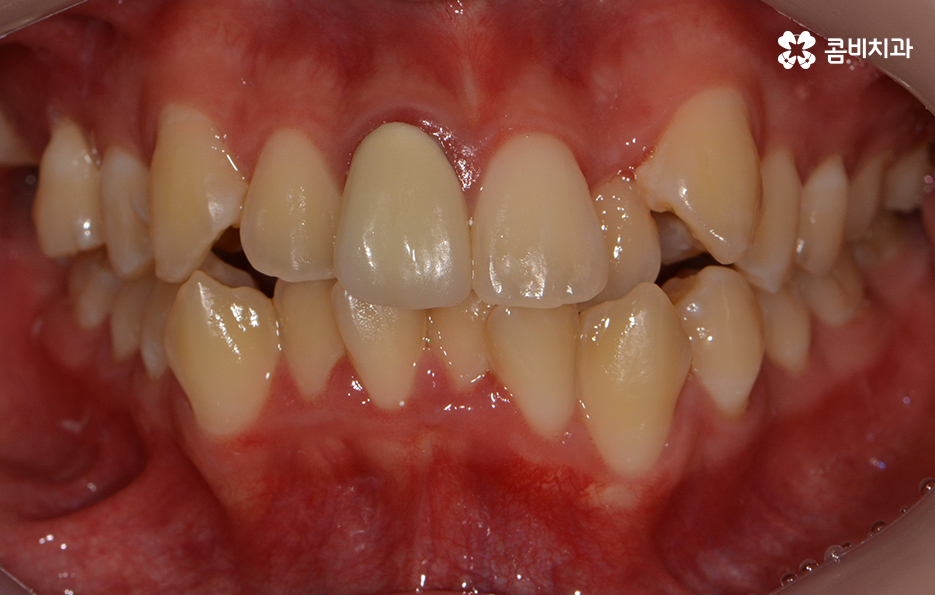 덧니교정 불편함이 느껴지지 않더라도 관련 이미지 1