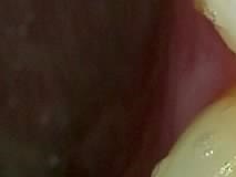어금니 임플란트 수명 어느정도나 지속될까 관련 이미지 16
