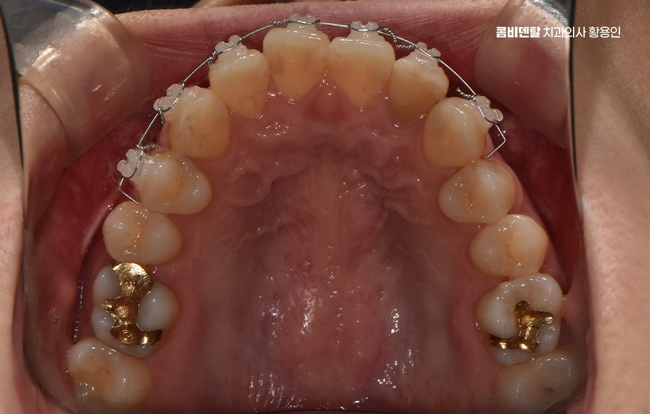 앞니 틀어짐 부분교정 얼마나 걸릴까 관련 이미지 9