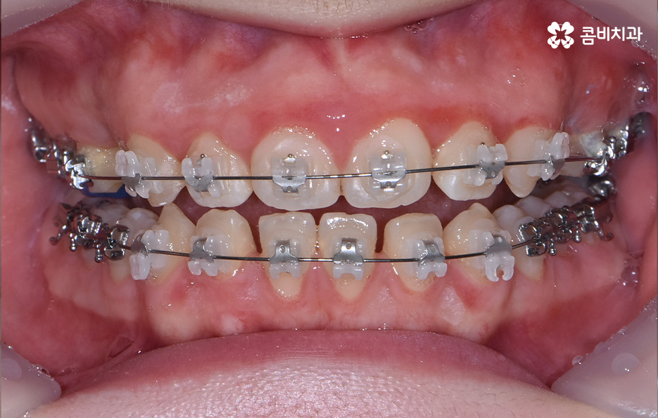치아 벌어짐 교정으로 앞니 돌출까지 해결하기 관련 이미지 6