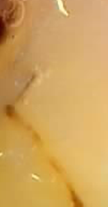 잇몸 고름주머니 방치 늦지않게 대처하려면 관련 이미지 19
