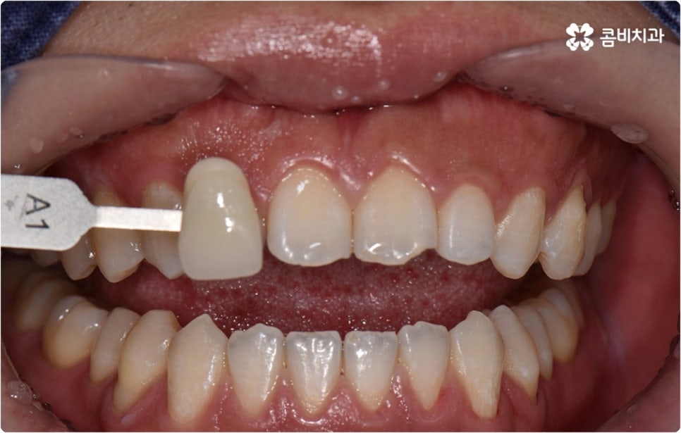 치아미백시술 관심있다면 관련 이미지 4