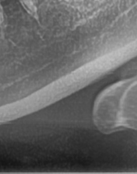 어금니 뒤 잇몸 부음 어떤 문제길래 이런거죠 관련 이미지 45