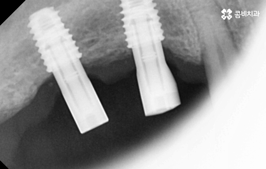 50대임플란트 각별하게 주의해야 하는 시기 관련 이미지 11