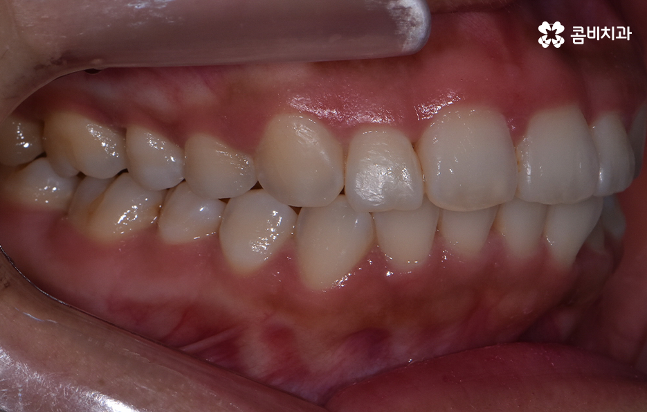앞니 틀어짐 교정 방법 이럴때는 좀더 간단해요 관련 이미지 7