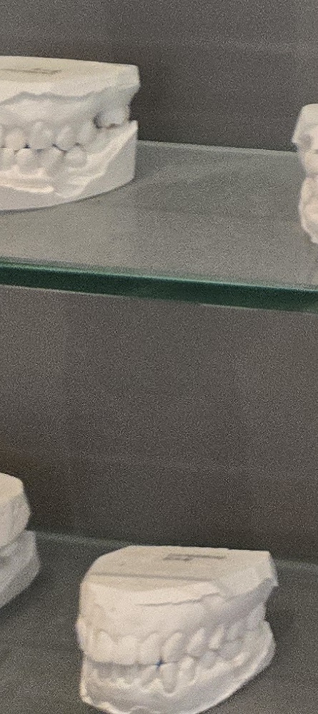 앞이빨 임플란트 과정 주의해야할 포인트는 관련 이미지 29