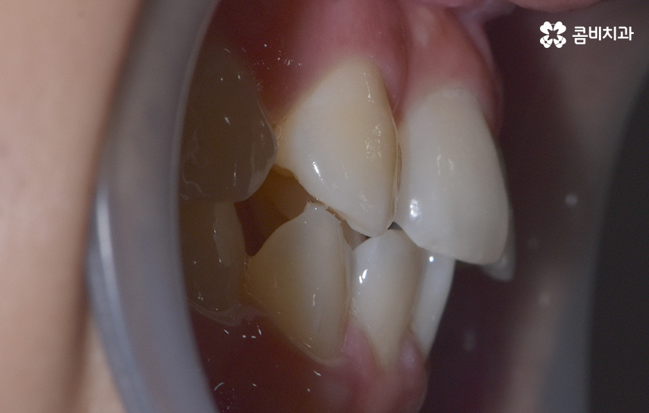 덧니 발치교정으로 교정할 때 치아가 이렇게 이동해요 관련 이미지 2