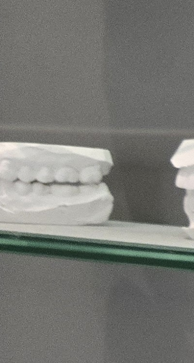 윗니 전체 임플란트 뭐부터 해야할까 관련 이미지 21