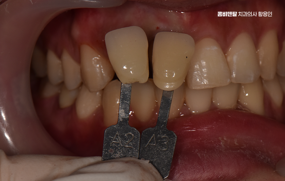깨진 앞니 크라운 어떻게 해야 깔끔하게 해결될까 관련 이미지 6