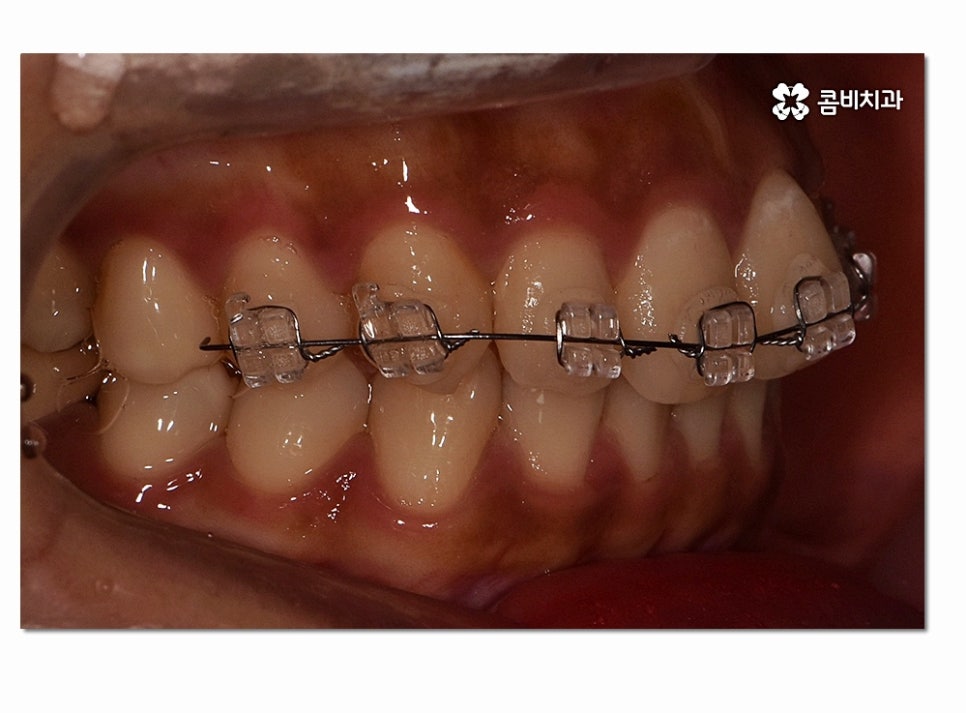 앞니 부분교정 오래 걸리지 않고 원하는 부위만 관련 이미지 7