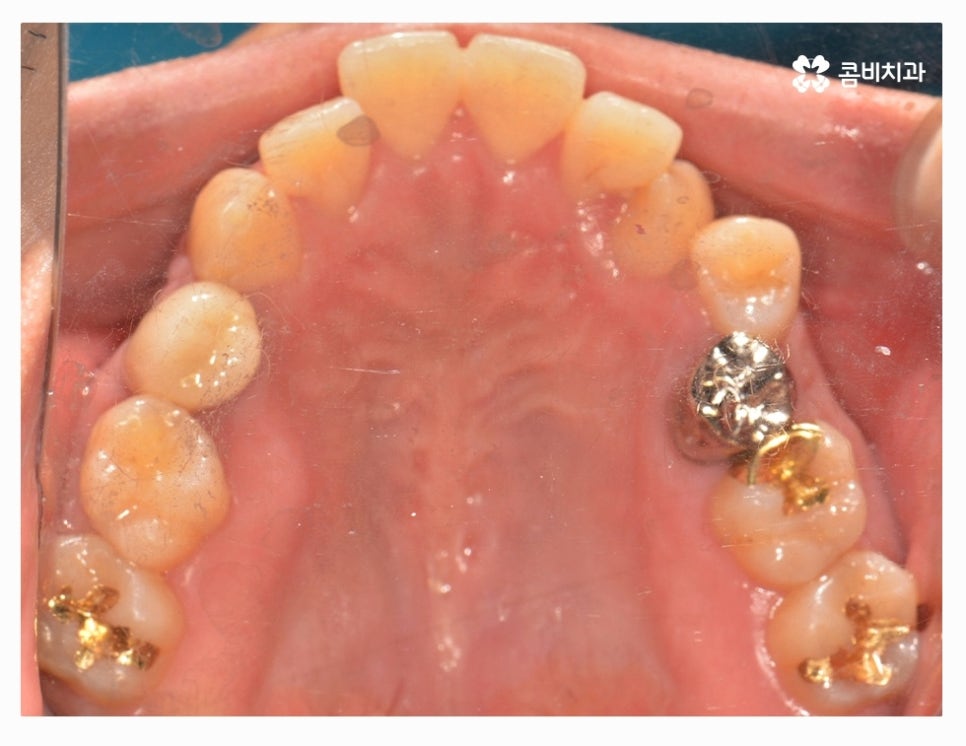 클리피씨교정 올바르게 판단하려면 관련 이미지 4