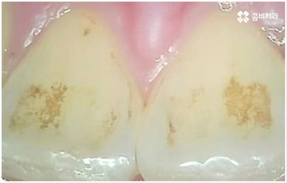 충치 통증 참지마세요 관련 이미지 2