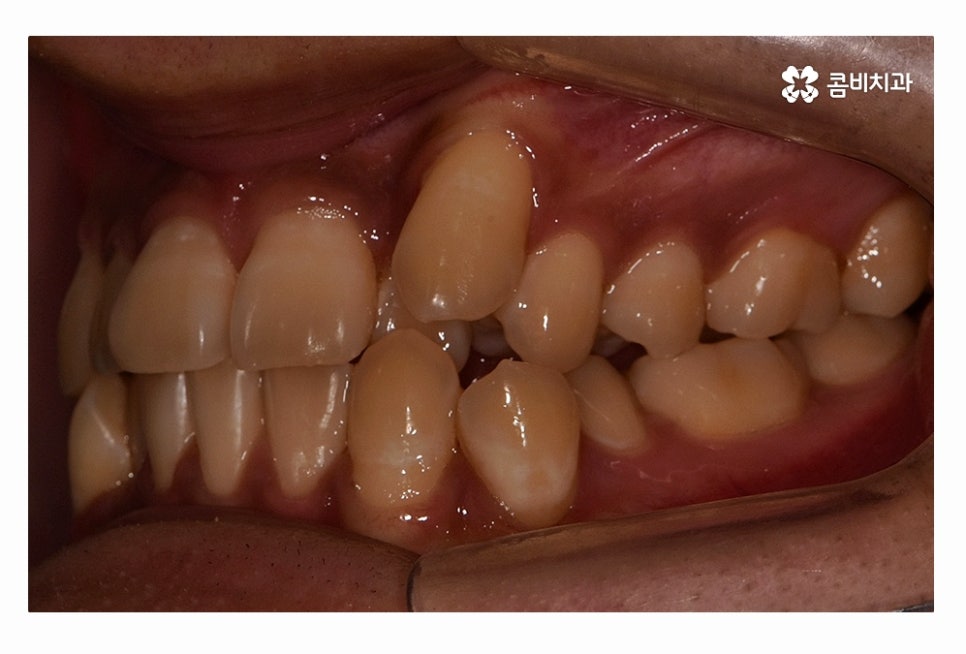 덧니 발치 필수적으로 하는건가요 관련 이미지 3