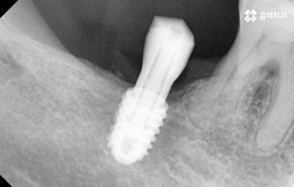 50대임플란트 각별하게 주의해야 하는 시기 관련 이미지 10