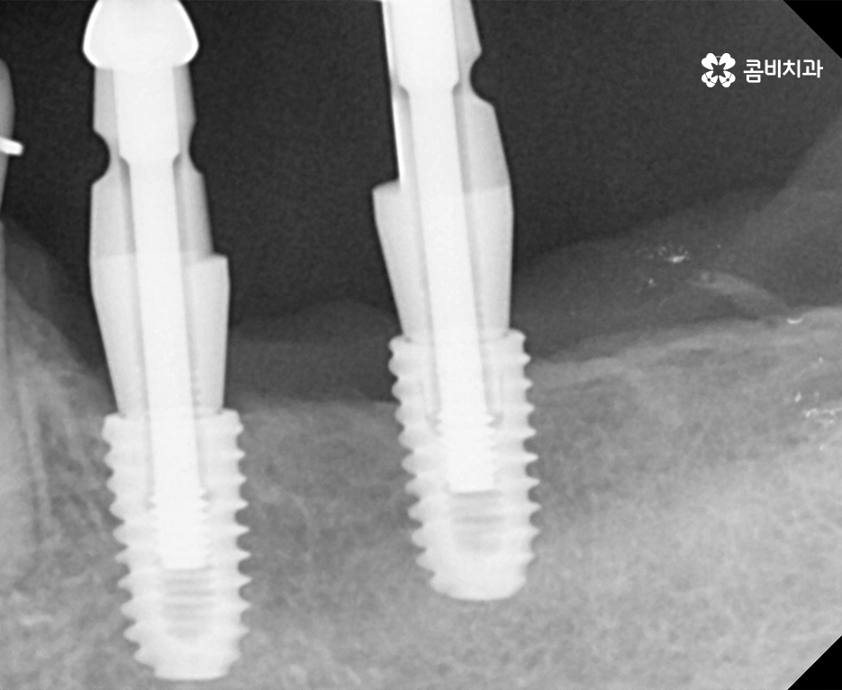 임플란트 치료기간 사람마다 다른 이유를 알아봐요 관련 이미지 7