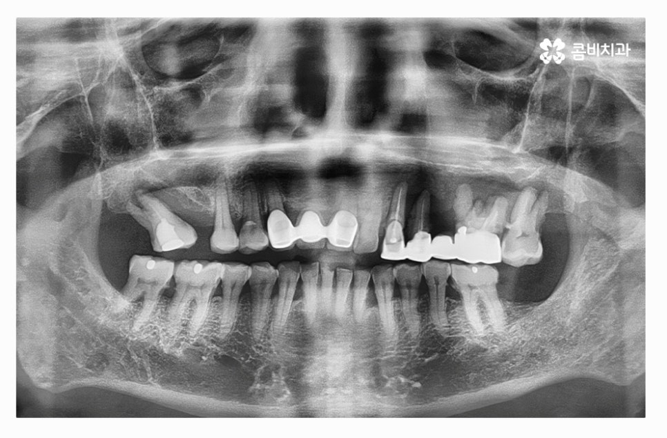 전체임플란트 신중하게 결정하려면 관련 이미지 1