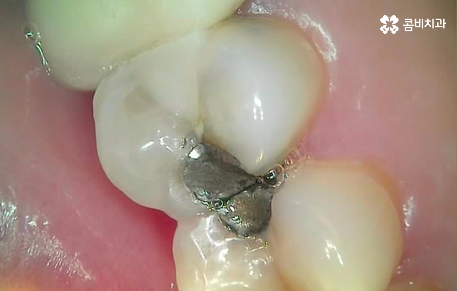 명동치과 놓치기 쉬운 2차충치에 주의하려면 관련 이미지 5