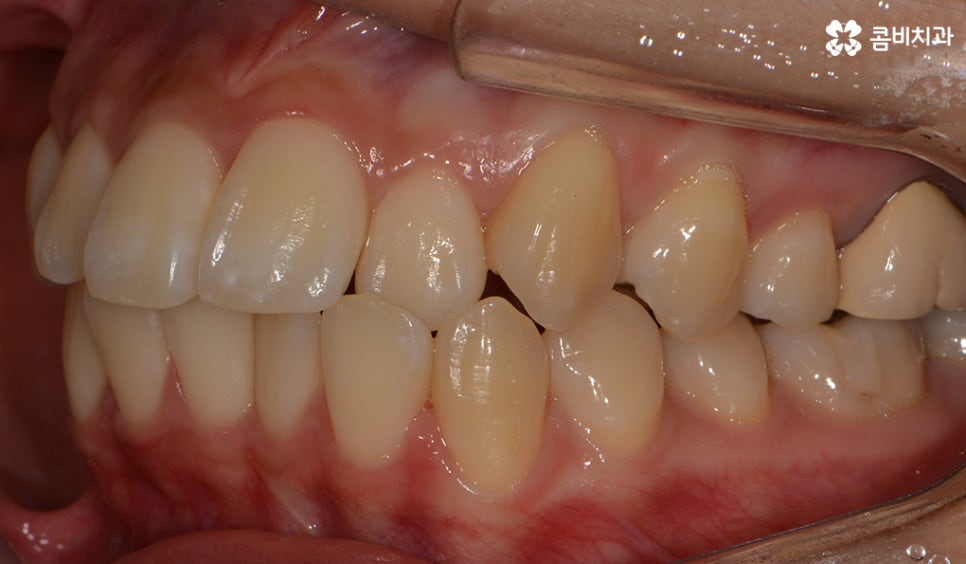 콤비교정 나에게 적합한지 판단하려면 관련 이미지 4