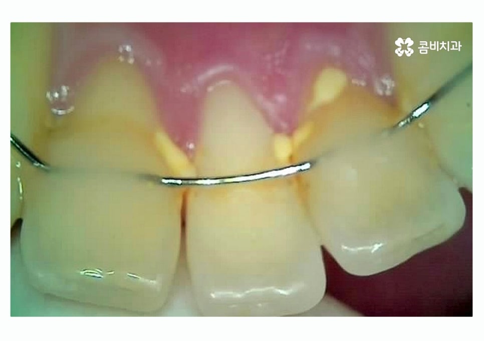 충치 떼우기 스무살이후에 조심해야 할 점은? 관련 이미지 9