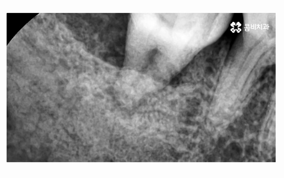 어금니 발치 심각해지기 전에 막으려면 관련 이미지 6