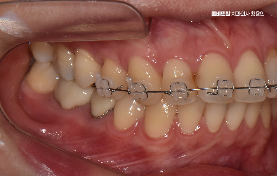 앞니 틀어짐 부분교정 얼마나 걸릴까 관련 이미지 7