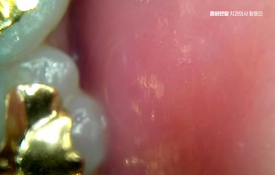 어금니 뒤 잇몸 부음 어떤 문제길래 이런거죠 관련 이미지 2