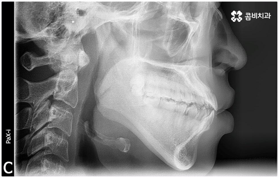 부정교합 3급 왜 고쳐야 하나요 관련 이미지 1
