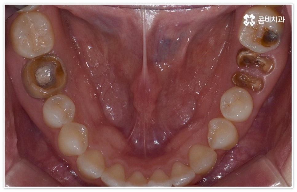 신경치료통증 무섭다고 미루면 관련 이미지 4