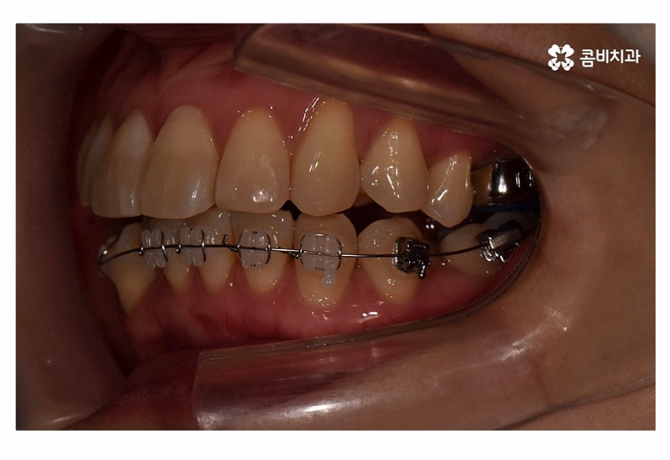 치아설측교정 가능한지 궁금하다면 관련 이미지 7