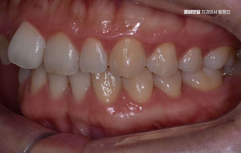 치아교정 통증 줄이는 방법 어떻게 가능할까요 관련 이미지 3